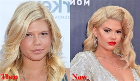 chanel west coast before surgery|Exclusive 